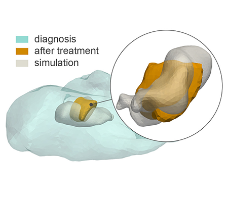 Patient-specific Multi-Scale Tumor Growth Modelling